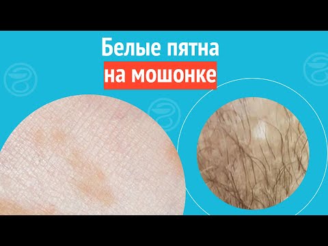 ▶️ Белые пятна на мошонке. Клинический случай №1297