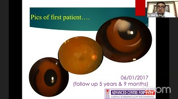 AIOC2021-GP47-Topic-Dr.DINESH GARG- Scleral fixation in Aniridia Eye