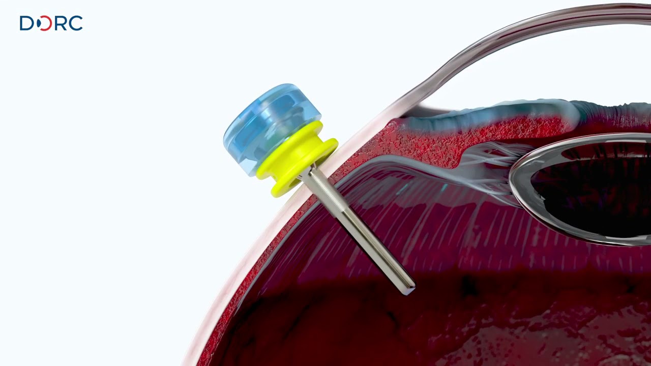 EVA AVETA™ trocar cannula system by DORC