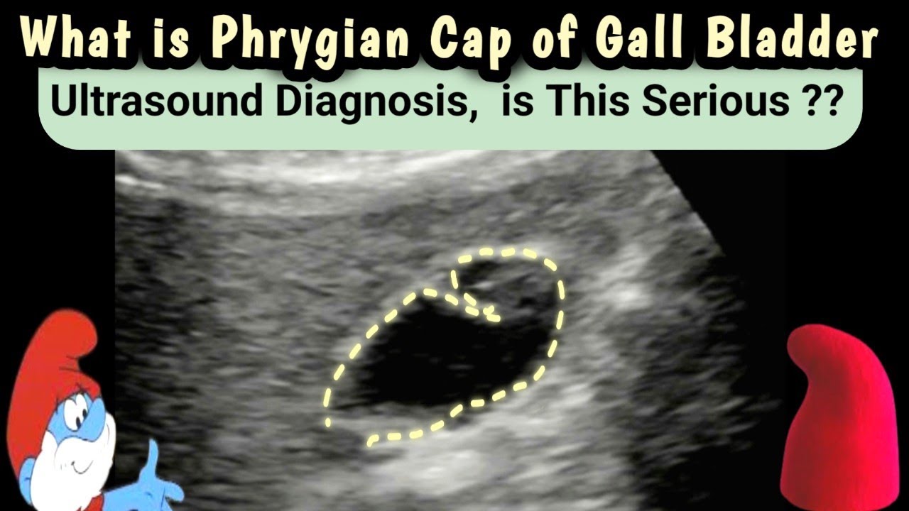 What is Phrygian Cap of Gall bladder | Ultrasound | Diagnosis | is this ...