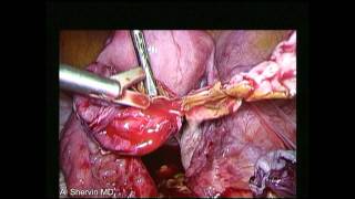 Endometrioma surgery based on it's anatomical structure