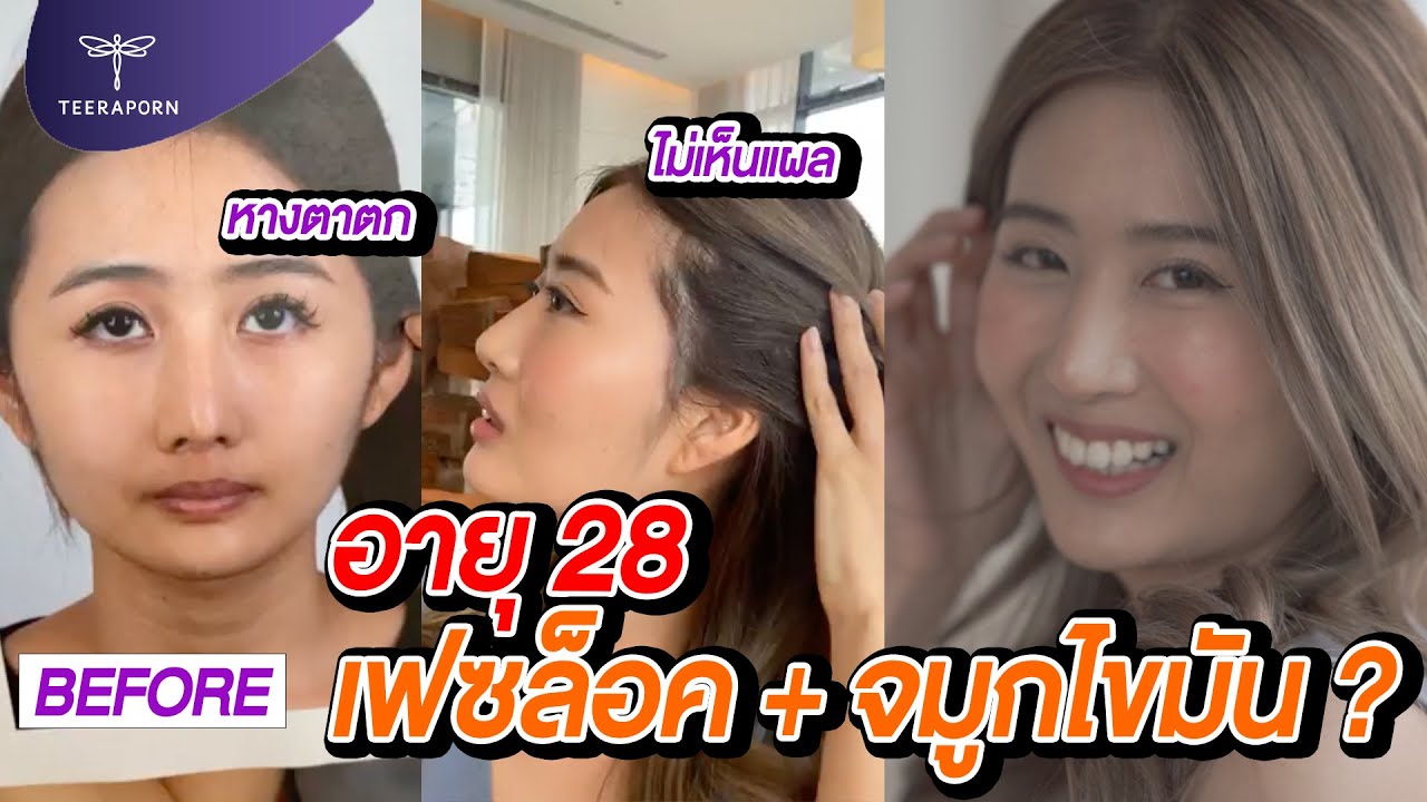 อายุ 28 ทำไมถึงทำเฟซล็อค+ธีรพรคลินิก จมูกไขมัน  หมอชลธิศ