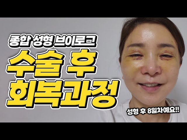 성형수술 회복과정 VLOG | 종합 성형 리얼 후기