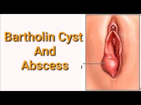 What Is Bartholin Cyst In Hindi By Nida Ali Youtube
