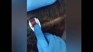 طريقة استخدام الديرما رولر لعلاج التساقط وانبات الشعر