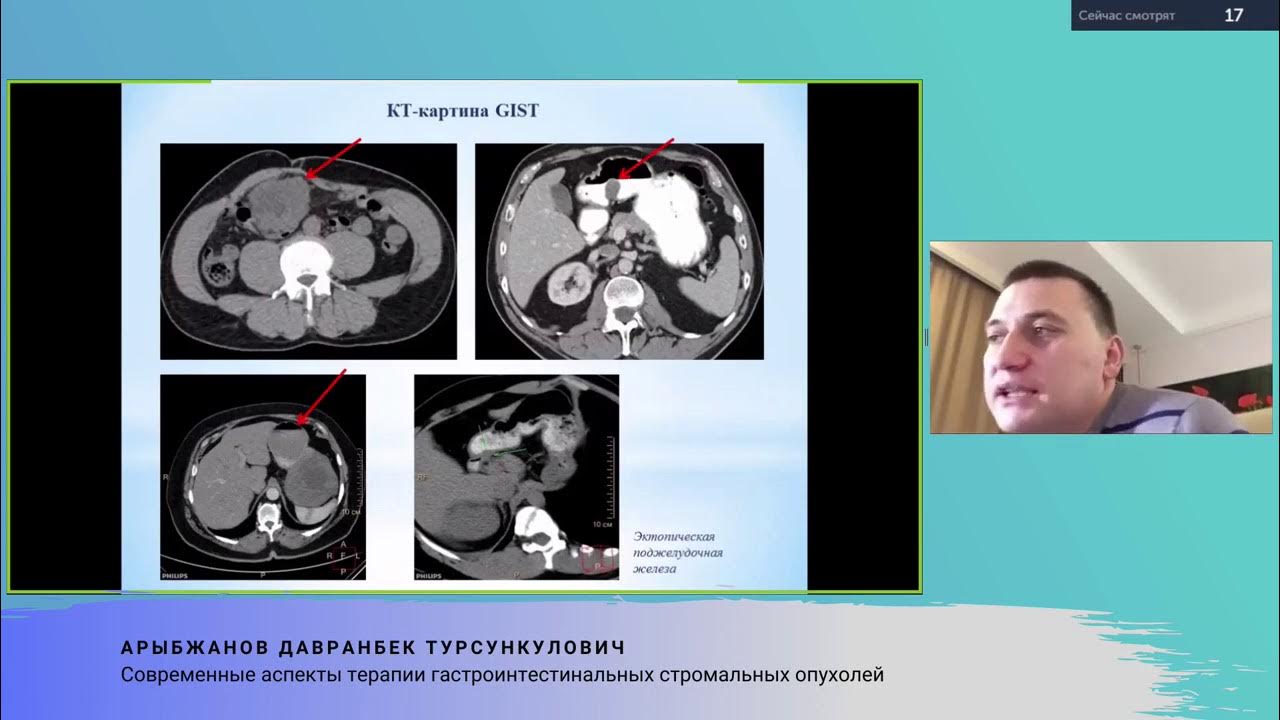 Tumor de gist esperanza de vida