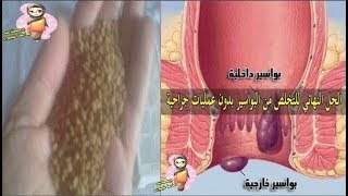 اكتشاف مذهل لعلاج البواسير الداخلية والخارجيه نهائيا في دقائق معدوده وقل وداعا للبواسير !