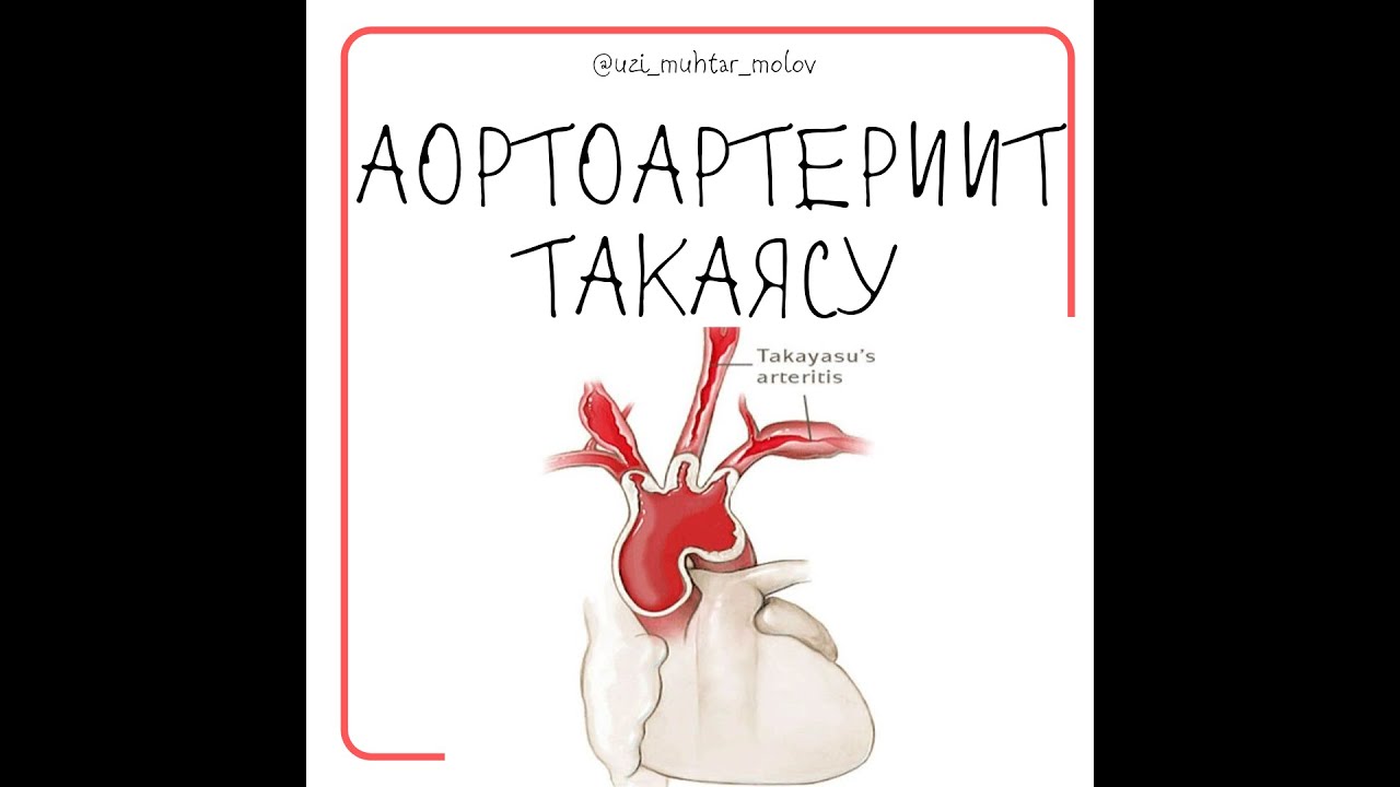 Аортоартериит Такаясу дуплексное сканирование сосудов шеи