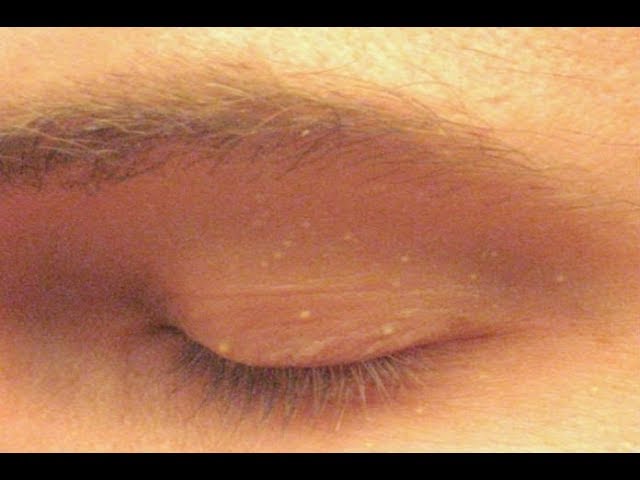 Вы когда-нибудь замечали на своем лице подобные белые пятна? Хотите узнать, что это такое?