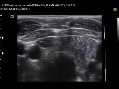 Вилочковая железа, тимус на УЗИ ребенку (21-8-17)