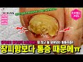 장화신고 일하신지 10년이상! 땀 많고 늘 젖어있는 발피부..발톱무좀.. 창피하기도 하지만 통증, 아픔때문에 왔어요..ㅠ #레푸스 #무좀발톱 #발톱무좀 #내성발톱 #파고드는발톱