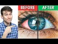 The #1 Best Natural Dry Eyes Treatment