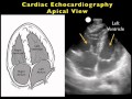 Cardiac Ultrasound - Apical View - SonoSite, Inc.