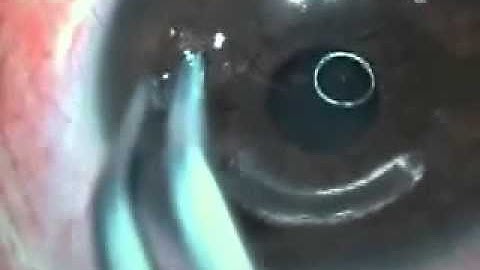 Intralaser Intacs Procedure