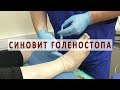 Что нужно знать о синовите голеностопного сустава