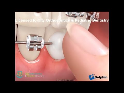 How to Apply Wax to Sore Areas | City Orthodontics & Pediatric Dentistry Edmonton
