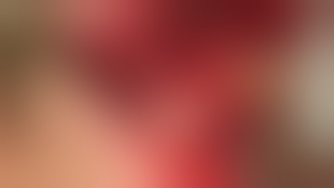 Lateral Bone Augmntation by Bone Block Autograft( Symphysis)