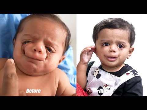 One in A Million Type Super Rare Birth Defect Baby 6 Months After Surgery