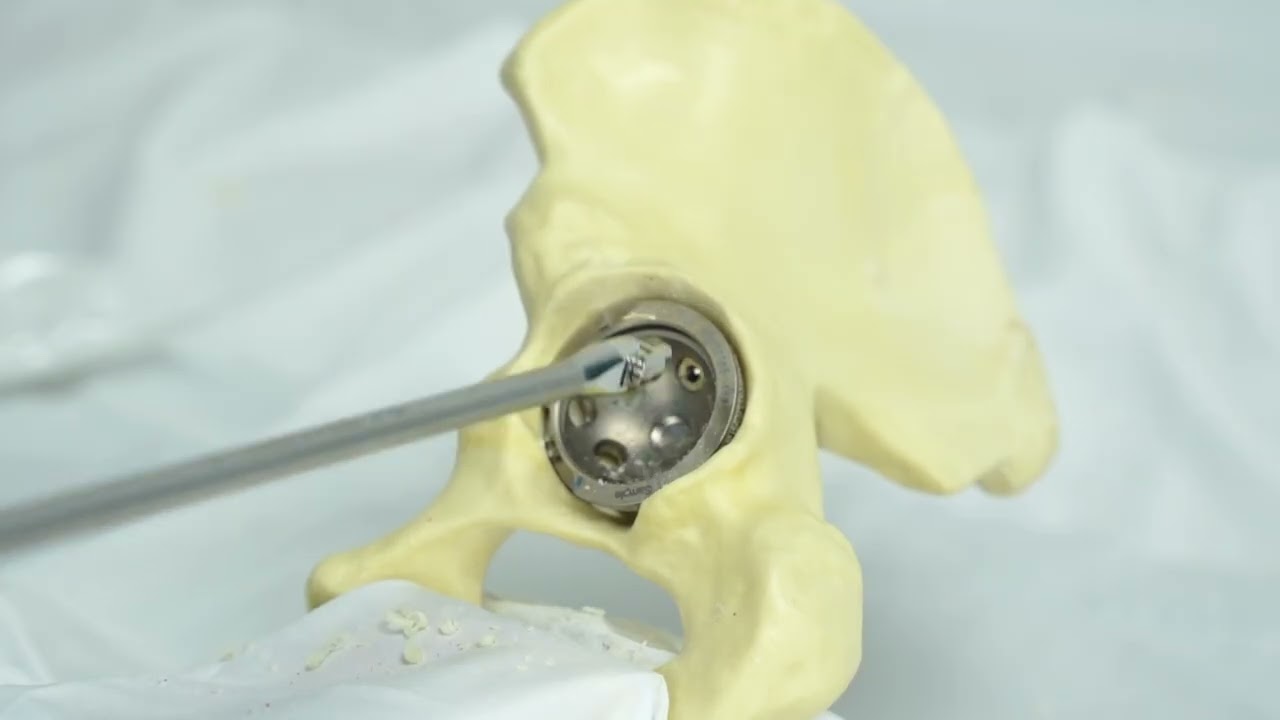 RingFix Cup Surgical Technique 2025