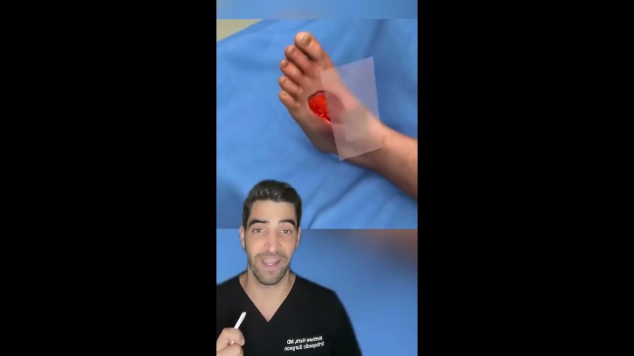 Skin Graft