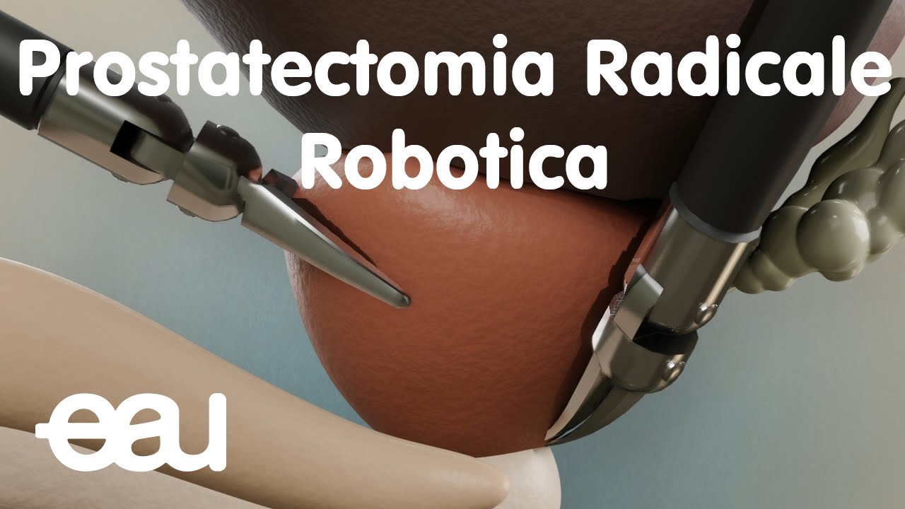 Prostatectomia Radicale Robotica