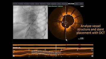 Mentice - Coronary Intermediate
