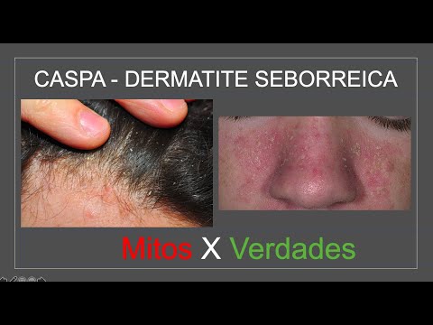 Vídeo: Caspa Facial (Dermatite Seborréica) Causas E Tratamentos