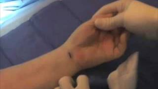 endoscopic carpal tunnel surgery live