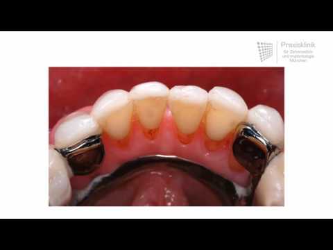 Replacing missing teeth: Different dentures and how they work
