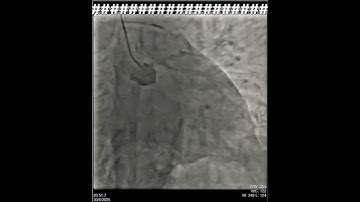RCA TOTAL OCCLUSION #shorts #youtubeshorts #angiography