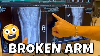 BROKEN ARM #4 | PART 5: BROKEN ARM X-RAY UPDATE + ANDREW BROKE HIS BRACES