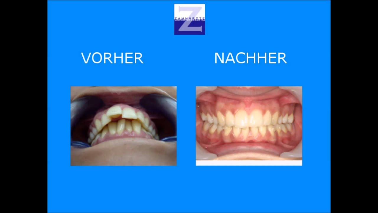 Unsichtbare Zahnspange Linz Wels Durchsichtige Zahnspange Aligner