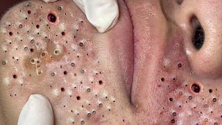 Relax Every Day With Treatment Satisfying blackhead relaxing acne, pimple, cyst by FISHING VIDEO 174 views 1 year ago 5 minutes, 6 seconds