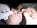 Young Woman's Huge Earwax is Finally Removed- She Seldom Cleans Her Ears