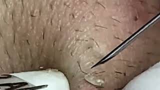 Blackhead Removal: Satisfying Routine - blackheads lips , Nose - ingrown hair removal   2025