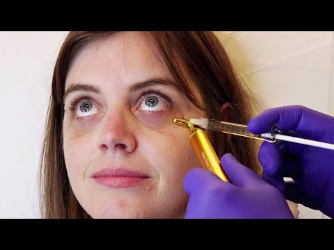 فيديو: 3 طرق لعلاج العين السوداء