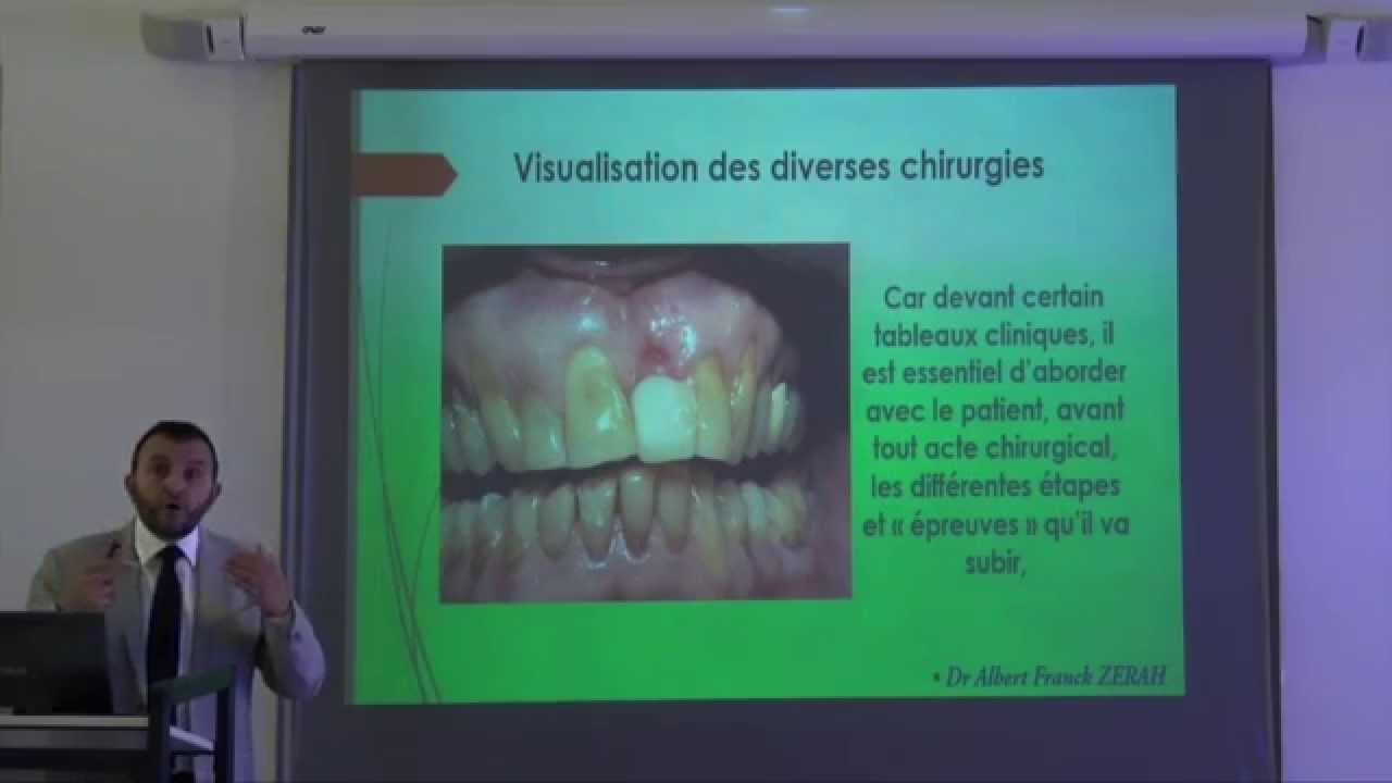 2ème commandement dentaire: empreintes, modèles d'étude et WAX UP