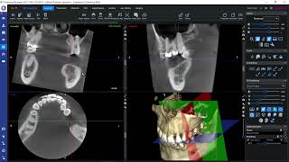 Navigating in 3D volumes in Planmeca Romexis®