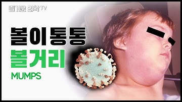 볼거리 (유행성이하선염) Mumps