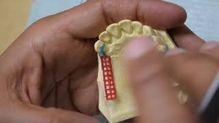 Partial Denture technology PRS362 video 3( Indirect retainer)