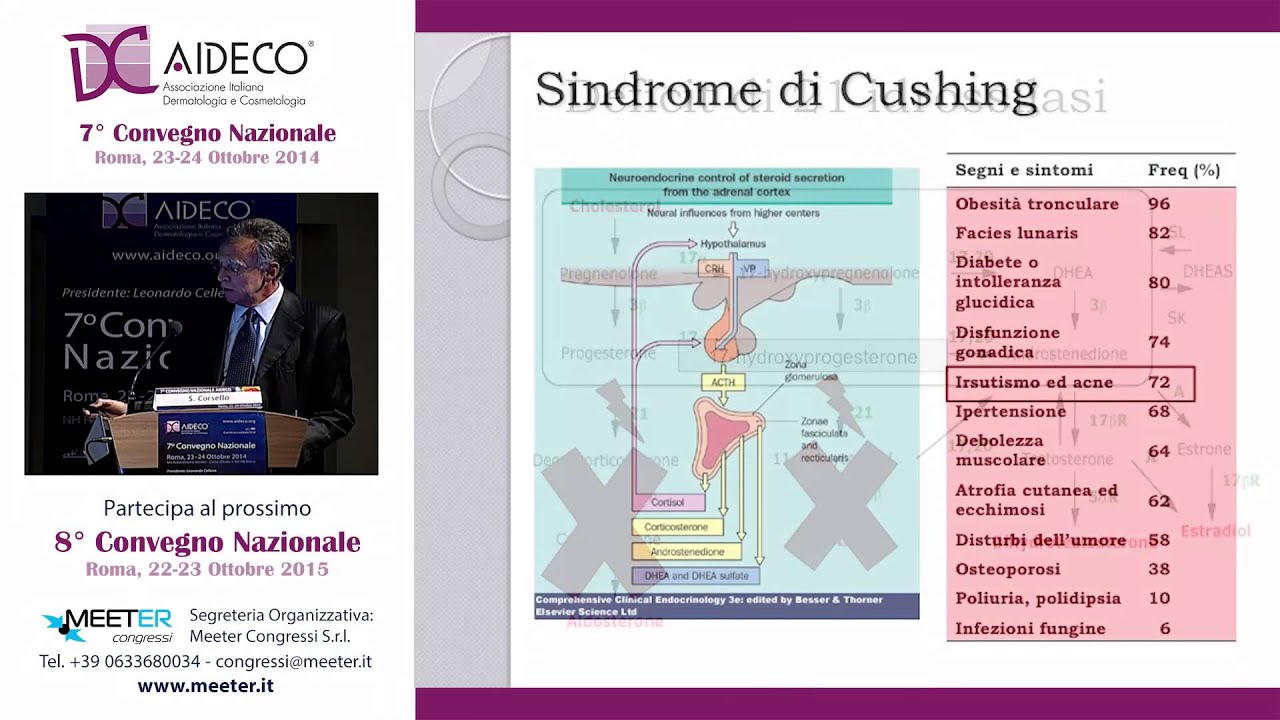 7° AIDECO 2014 - S. Corsello - L’irsutismo: diagnosi, ezio-patologia e terapia - part 2-2