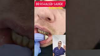 #shorts #cystremoval #skincare #pimplepopper #drkhaledsadek Dr Khaled Sadek Lipomacyst.com