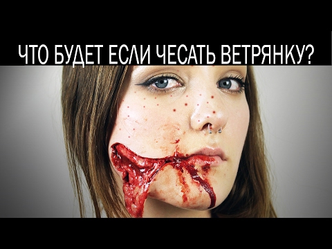 Что будет если чесать ветрянку