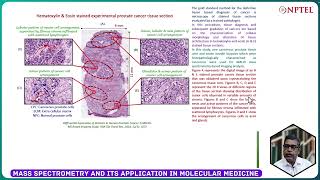 56. Imaging of human prostate cancer tissue using MALDI-MS