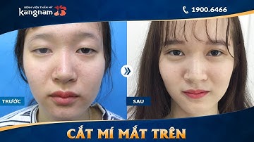 Cắt mí mắt trên Plasma sau 7 ngày tại Kangnam
