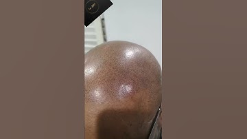 Scalp Micropigmentation first session results