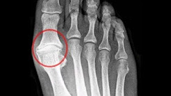 Big Toe Joint Pain: **Home  Treatment Guide**