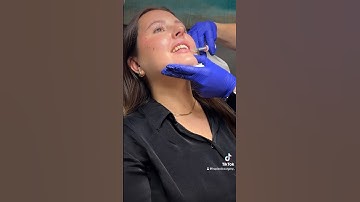 First time lip filler patient! Using Juvederm Ultra 💋