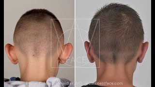 Facial Plastic Surgery For Men Seattle Washington Joseph Shvidler Md