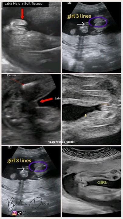 USG Janin Perempuan